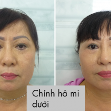 Chỉnh hở mi dưới 