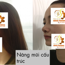 Nâng mũi cấu trúc