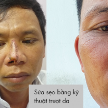 Sửa sẹo bằng kỹ thuật trượt da