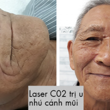 Laser C02 trị u nhú cánh mũi