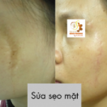 Sửa sẹo mặt