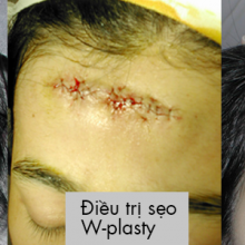 Điều trị sẹo W-plasty