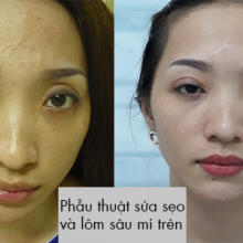 Phẫu thuật sửa sẹo và lõm sâu mi trên