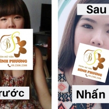 Nhấn mí 