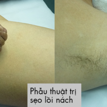 Phẫu thuật trị sẹo lồi nách