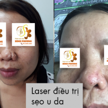 Laser điều trị u da