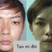 Tạo mí đôi