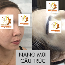 Nâng mũi cấu trúc